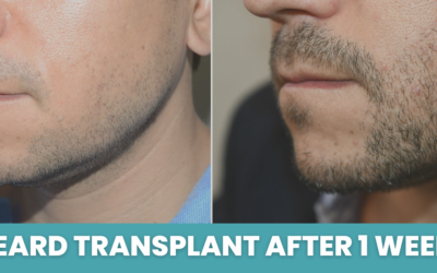 Beard transplant after 1 week