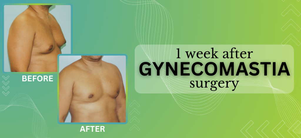 1 week after Gynecomastia Banner