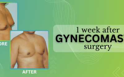 1 Week After Gynecomastia Surgery