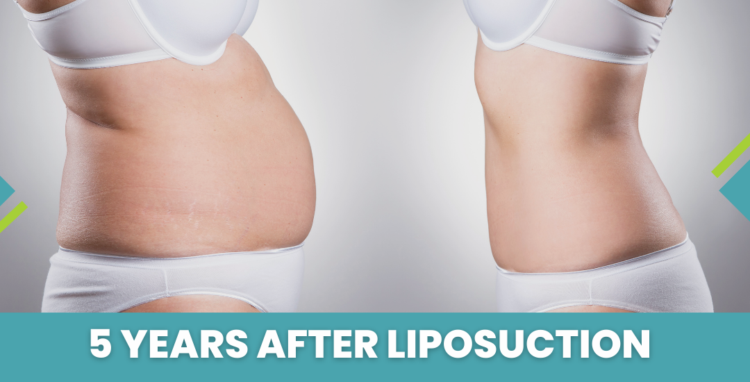 5 Years After Liposuction
