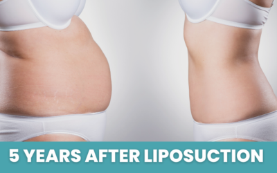 5 Years After Liposuction