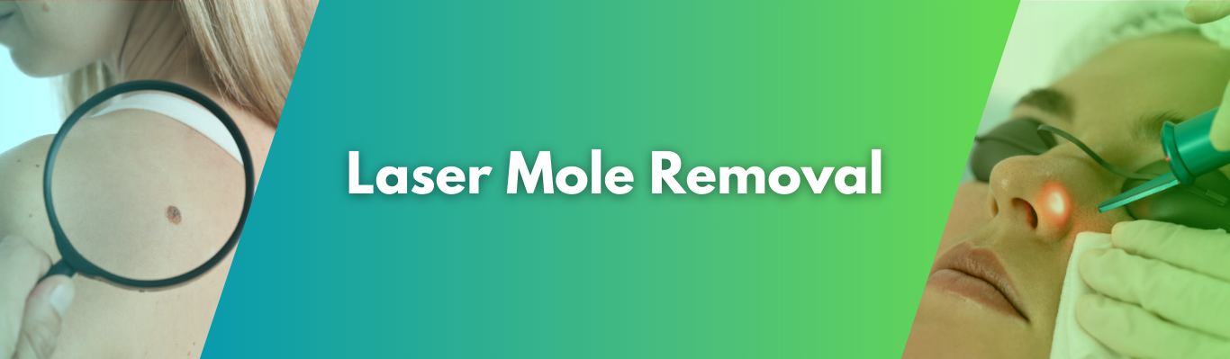 Laser Mole Removal