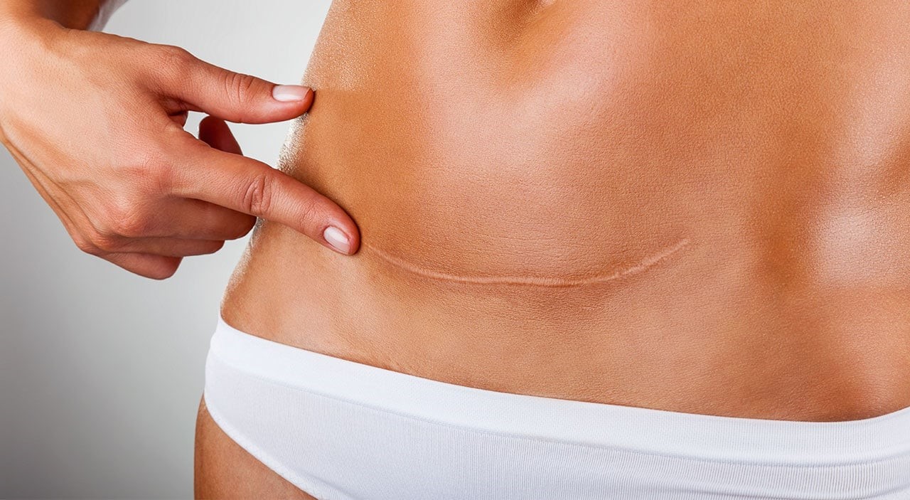 A Mini Tummy Tuck