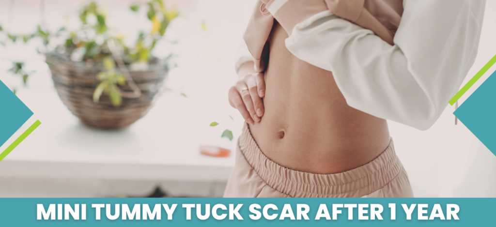 Mini_tummy_tuck_scar_after_1_year