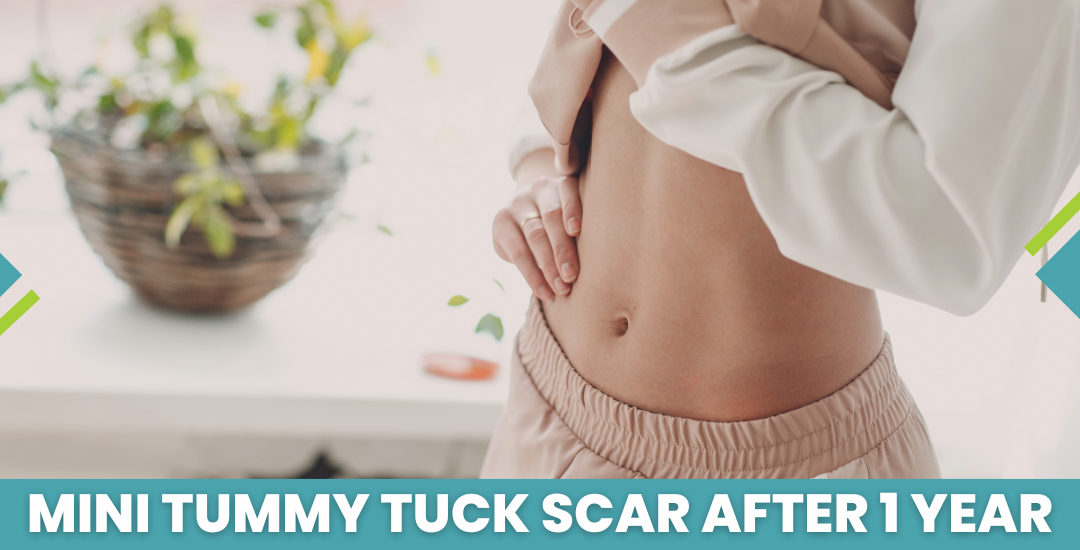 Mini Tummy Tuck Scar After 1 Year