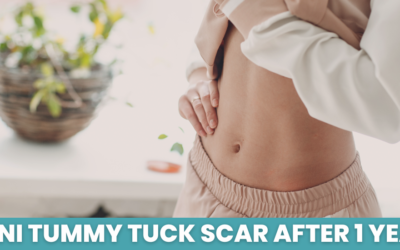 Mini Tummy Tuck Scar After 1 Year