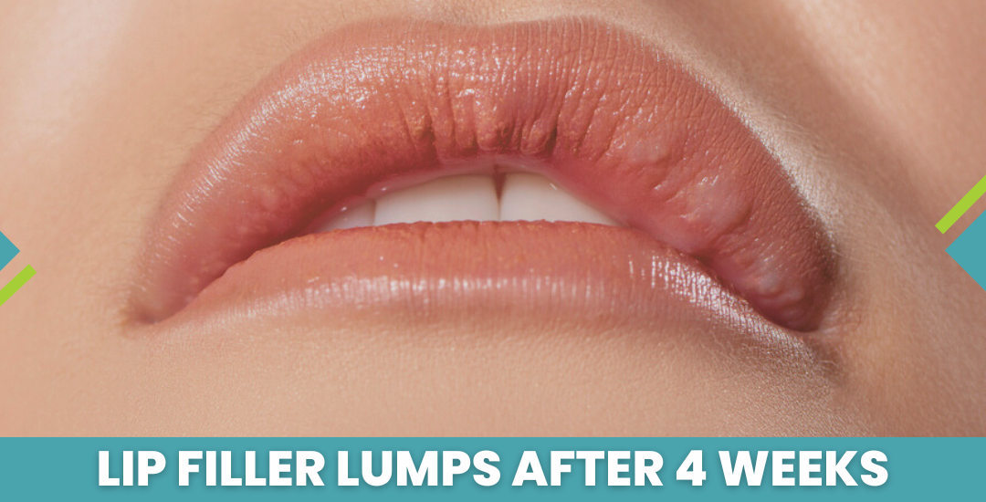Lip Filler Lumps After 4 Week