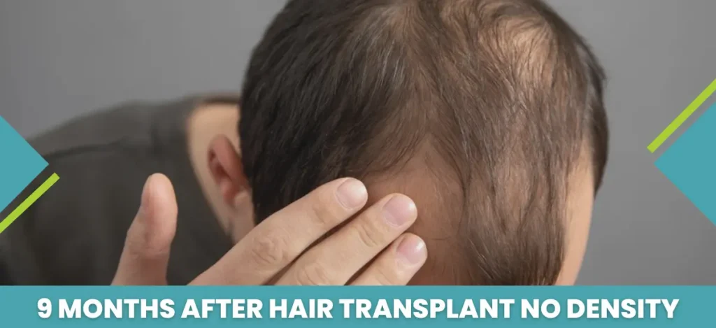 9_Months_After_Hair_Transplant_No_Density