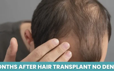 9 Months After Hair Transplant No Density: Causes & Solutions