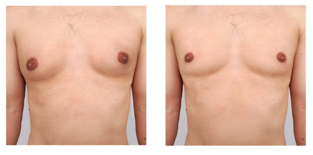 Gynecomastia Treatment