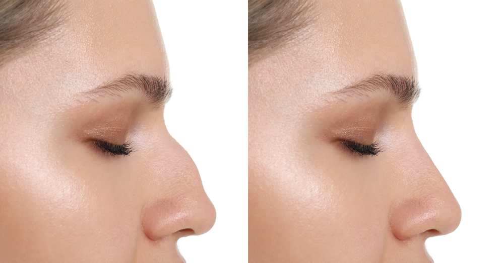 Rhinoplasty