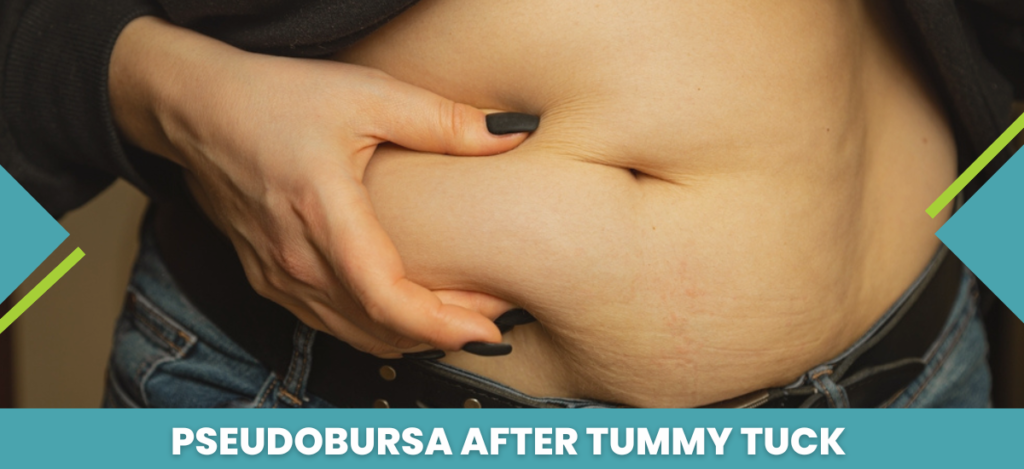 Pseudobursa After Tummy Tuck