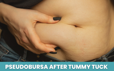 Pseudobursa After Tummy Tuck