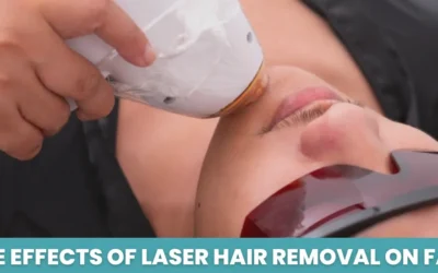 Side Effects of Laser Hair Removal on Face