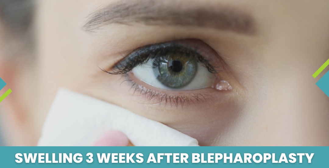 Swelling 3 Weeks After Blepharoplasty: Understanding the Healing Journey