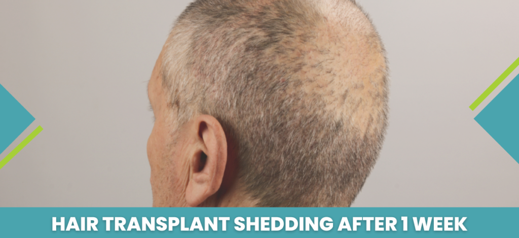 Hair_Transplant_Shedding_After_1_Week_1