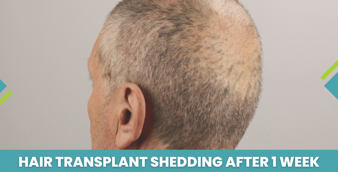 Hair Transplant Shedding After 1 Week: What to Expect and How to Manage It