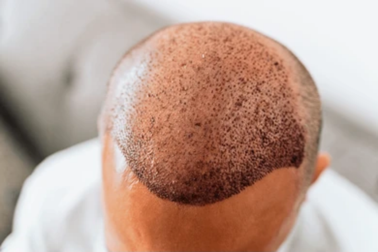 Shedding vs. Graft Loss: What’s the Difference?