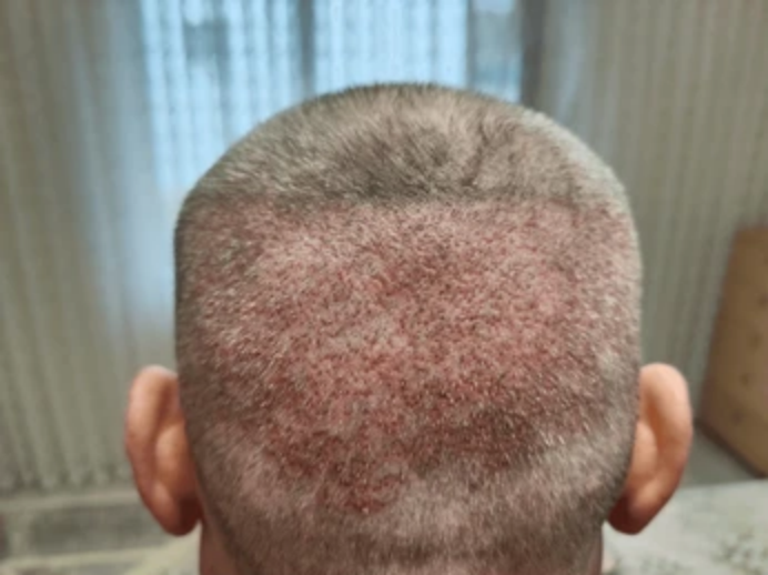 What to Expect in the First Few Weeks Post-Transplant