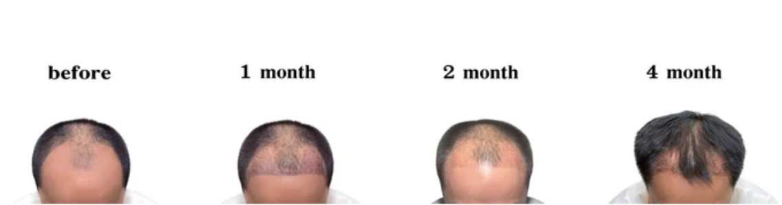 Post-Shedding Phase (Regrowth Timelines)