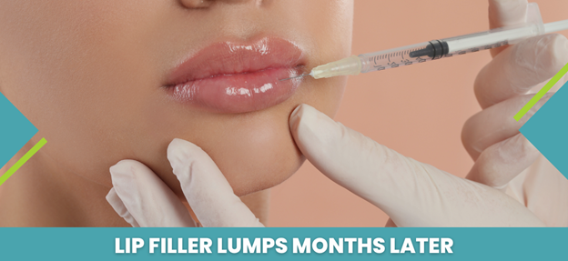 Lip Filler Lumps Months Later