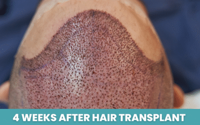4 Weeks After Hair Transplant