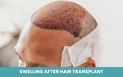 Swelling After Hair Transplant