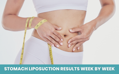Stomach Liposuction Results Week by Week