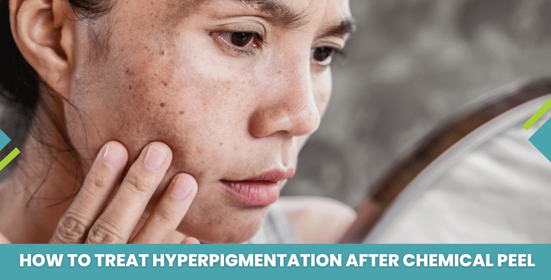 How to Treat Hyperpigmentation after Chemical Peel