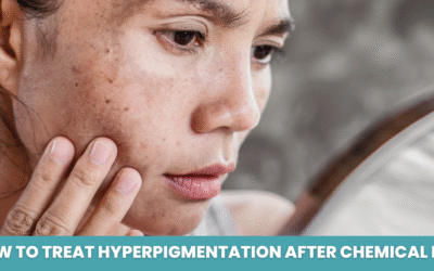 How to Treat Hyperpigmentation after Chemical Peel