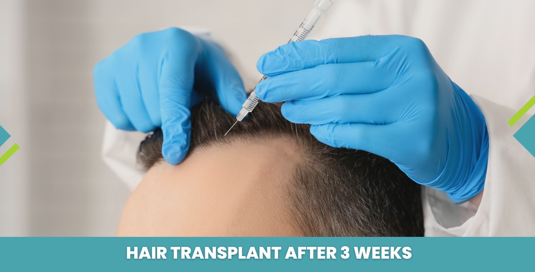 Hair Transplant After 3 Weeks: Recovery, Results & Red Flags