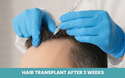 Hair Transplant After 3 Weeks: Recovery, Results & Red Flags