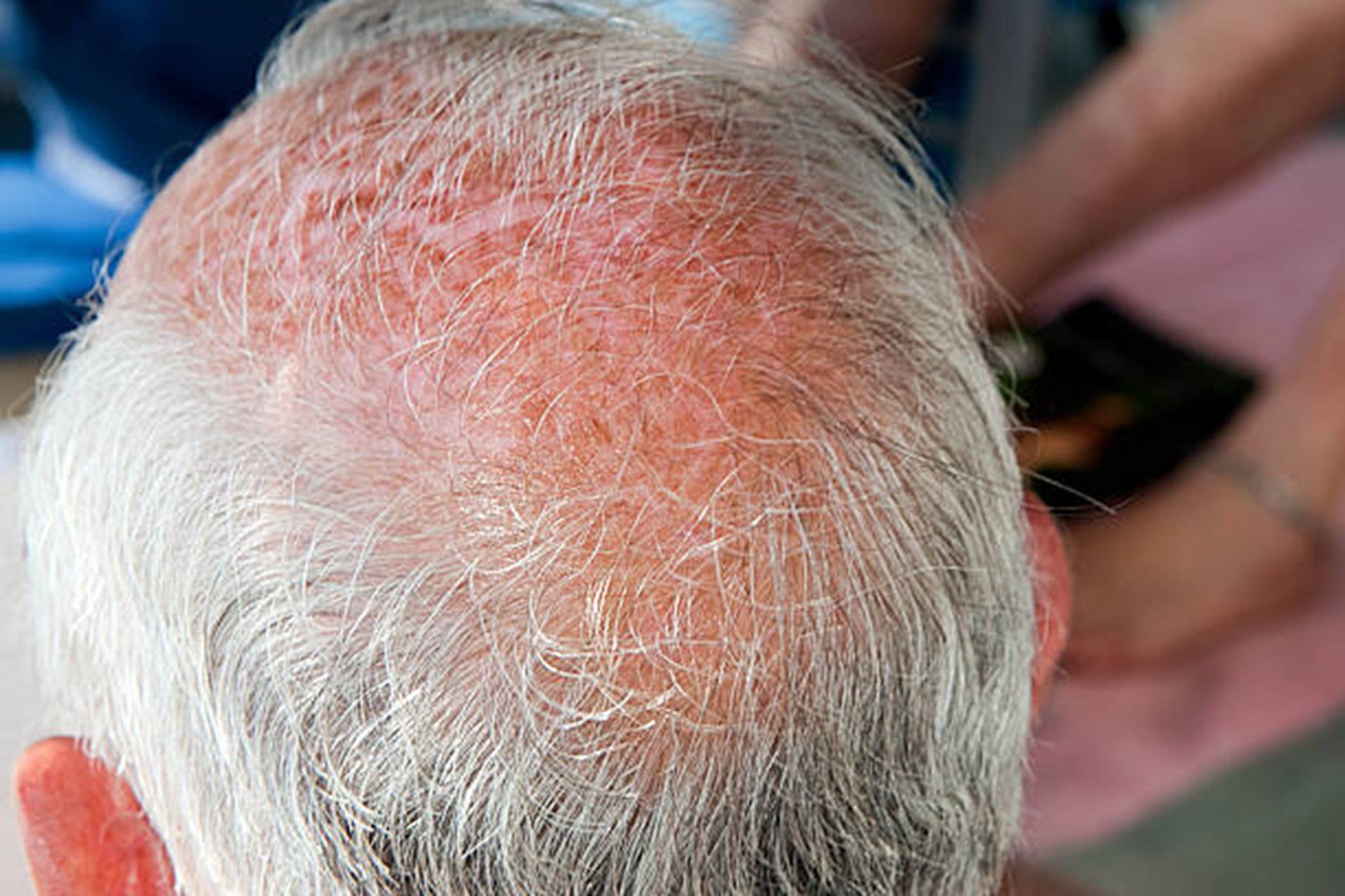 Scalp-Rejuvena Cosmo Care