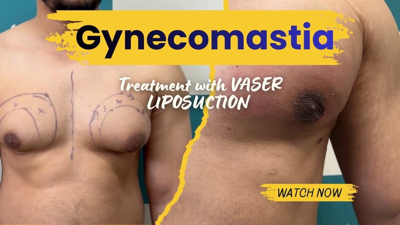 Gynaecomastia surgeon in Jaipur