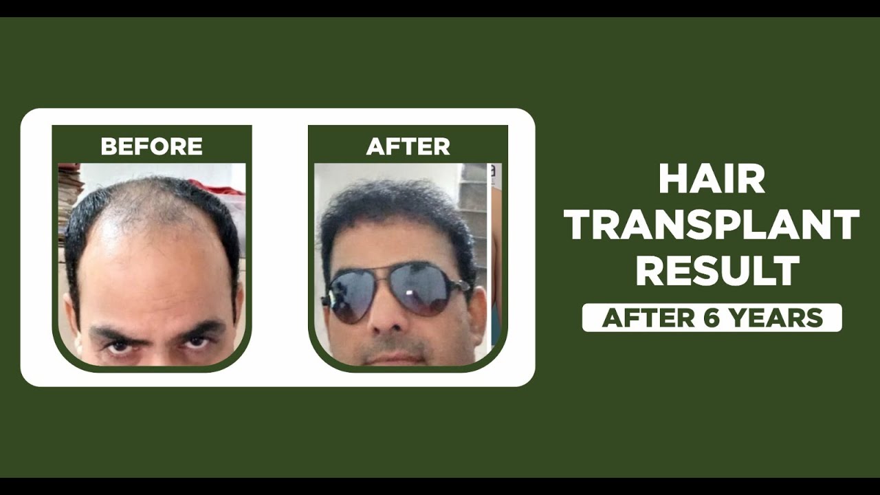 Hair Transplant in Jaipur