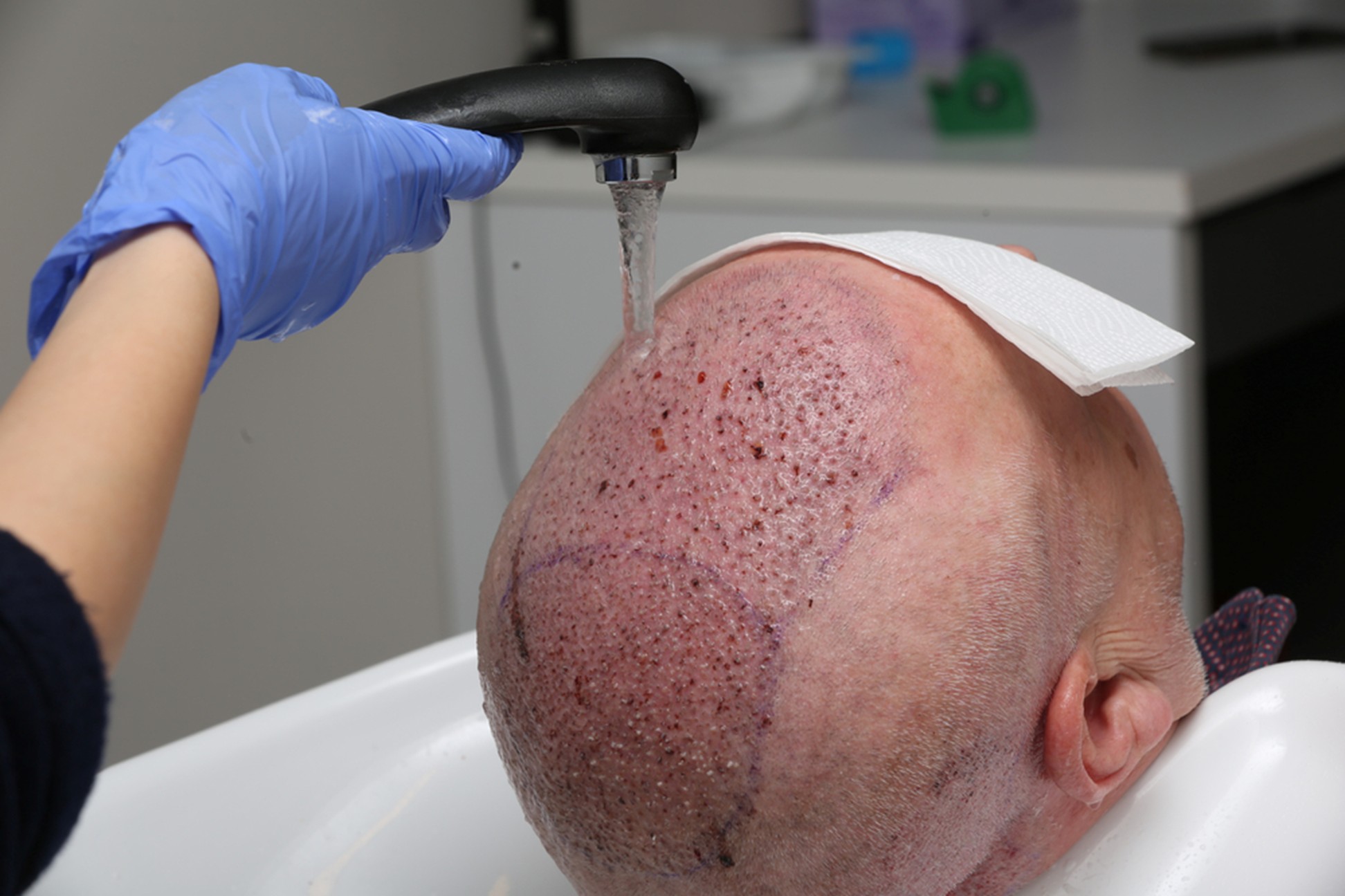 FUE patient gentle hair wash- Rejuvena Cosmo Care