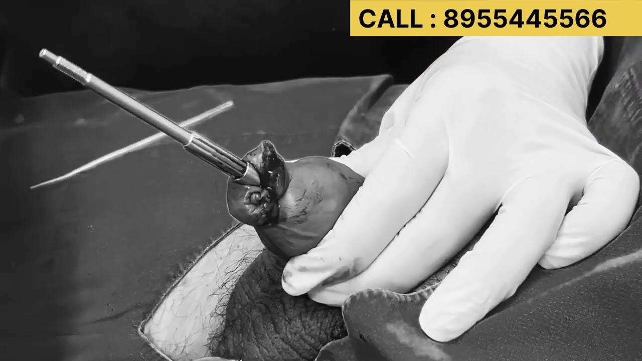 ZSR Circumcision in Jaipur