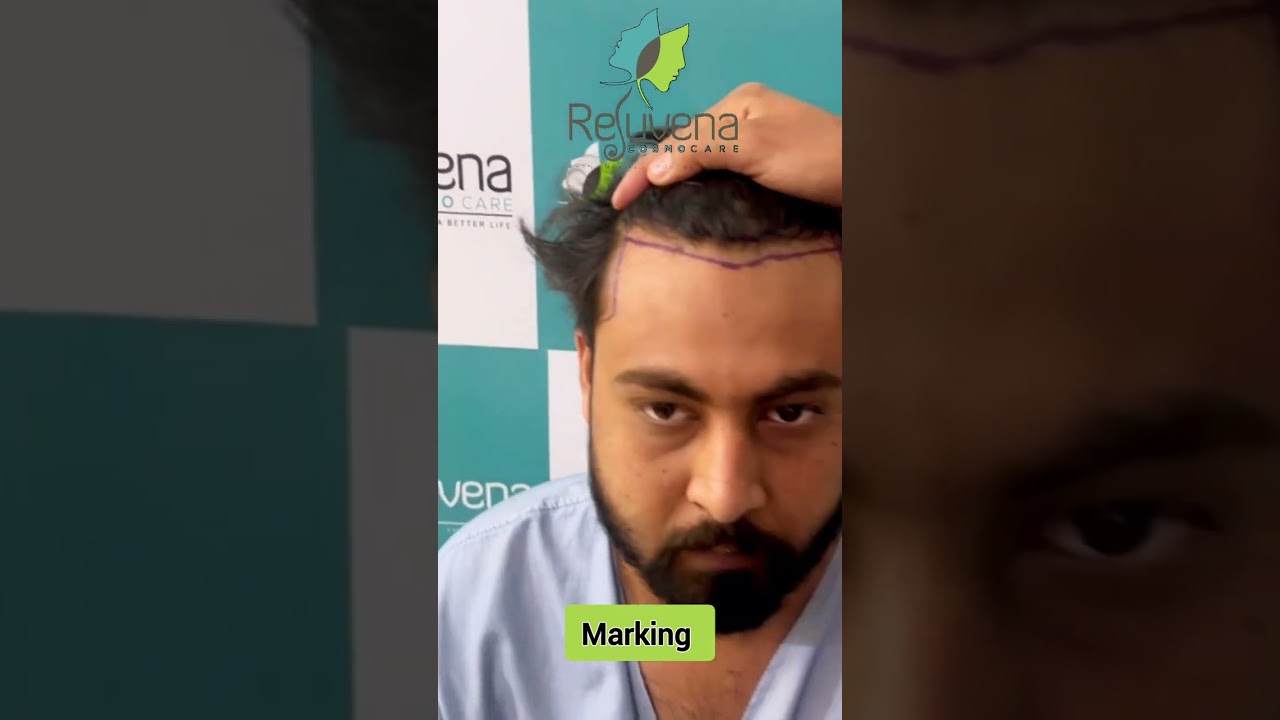 Hair Transplant Before & After results_Rejuvena Cosmo Care