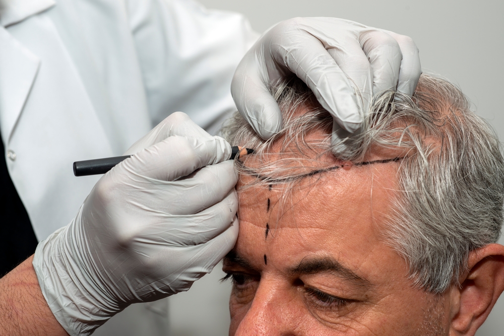Diagram showing facial thirds and ideal hairline position for hair transplant planning