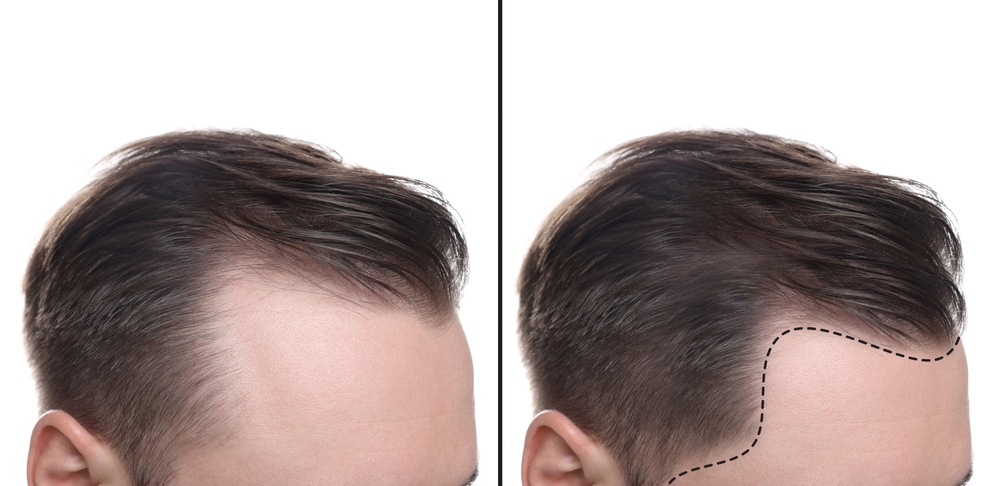 Patient with a natural-looking hairline after hair transplant at Rejuvena Cosmo Care, Jaipur