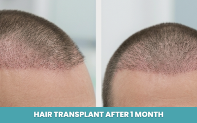 Hair Transplant After 1 Month: What to expect