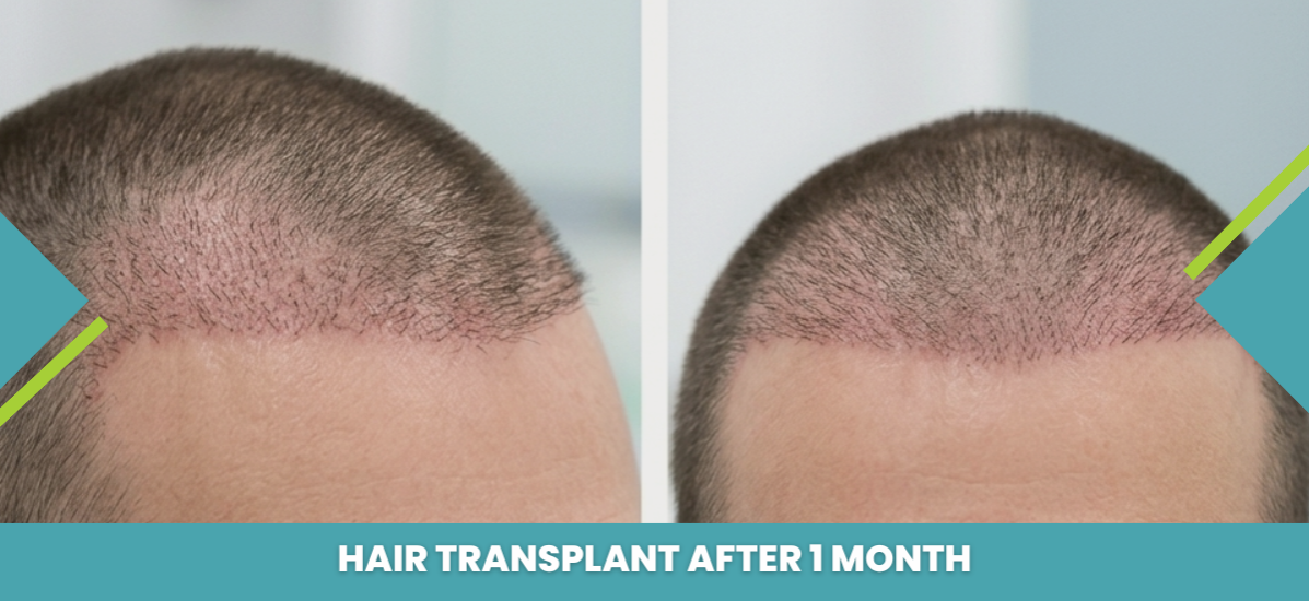 Hair transplant 1 month progress - scalp healing and recovery at Rejuvena Cosmo Care Jaipur