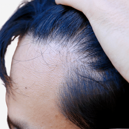 Thinning Hairline Due to Age or Stress - Hair Transplant Jaipur