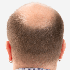 Male Pattern Baldness Androgenetic Alopecia - Hair Loss Cause
