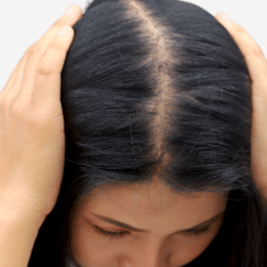 Female Pattern Hair Loss Illustration - Hair Transplant Jaipur