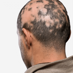 Alopecia Areata Hair Loss Type - Treatment at Rejuvena Cosmo Care