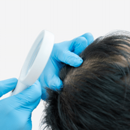Hair Loss from Injury Burns or Surgery - Hair Transplant Candidate