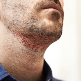 Beard Transplant in Jaipur - FUE Beard Restoration by Dr. Deepesh Goyal
