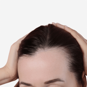 Female Hair Transplant in Jaipur - Women Hair Loss Treatment