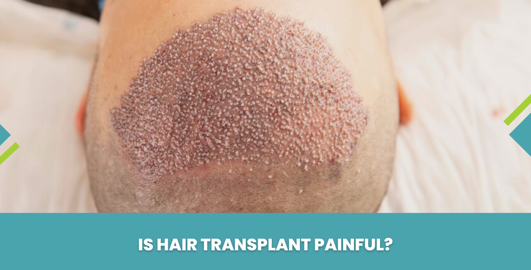 Is Hair Transplant Painful
